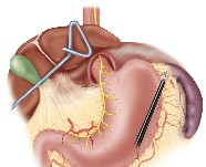 Laparoscopic | Division of gastric vessels