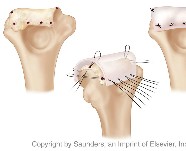 Distal humerus