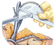 Elbow surgery