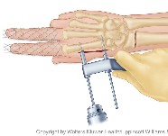 Fracture repair