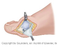 Hallus valgus