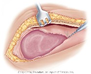 Opening left pleura