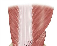 Tricep surgery